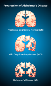 Alzheimer’s Disease | Brainsymphonics